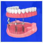 dental implants cost in mumbai